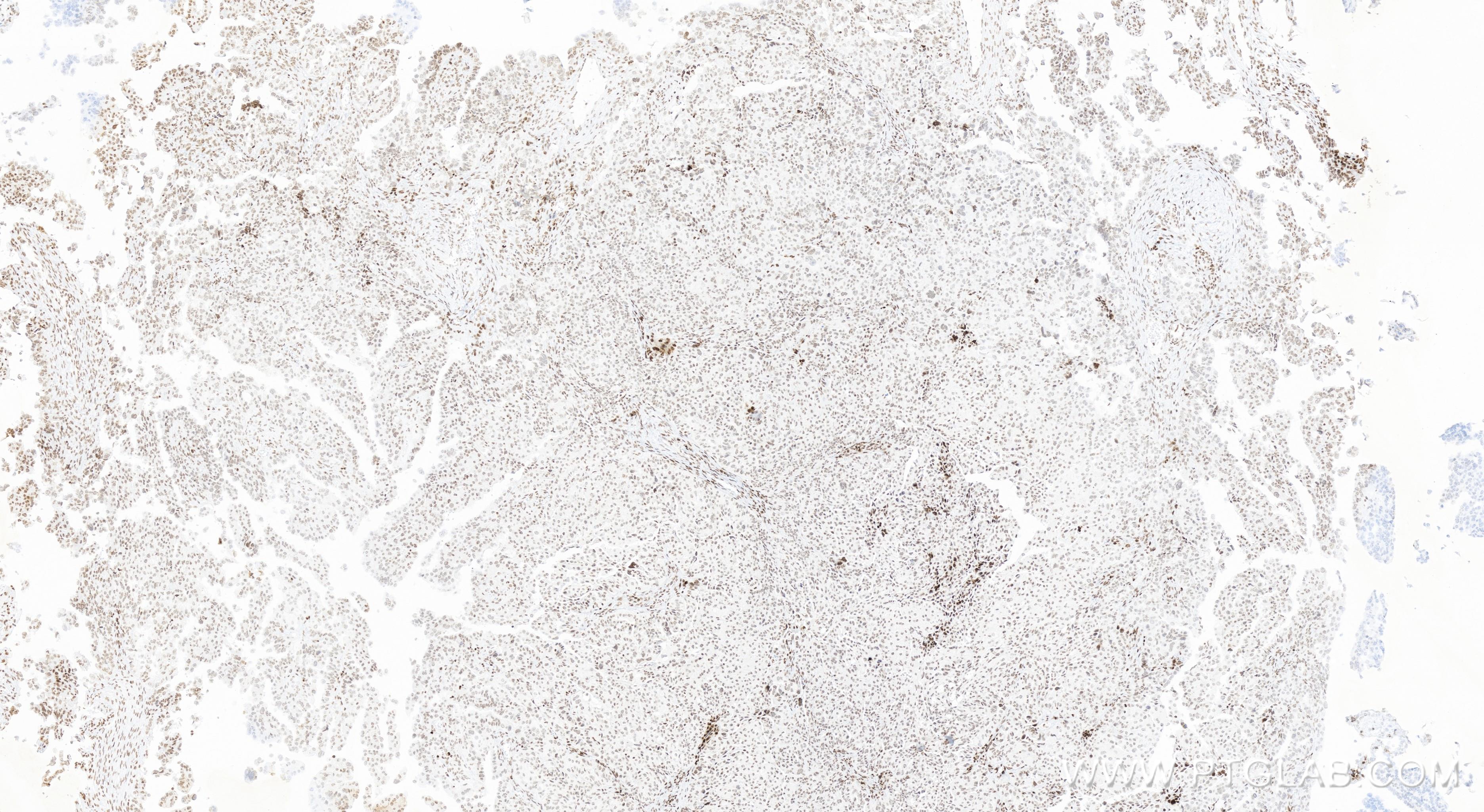 IHC staining of human ovary cancer using 84534-5-RR (same clone as 84534-5-PBS)