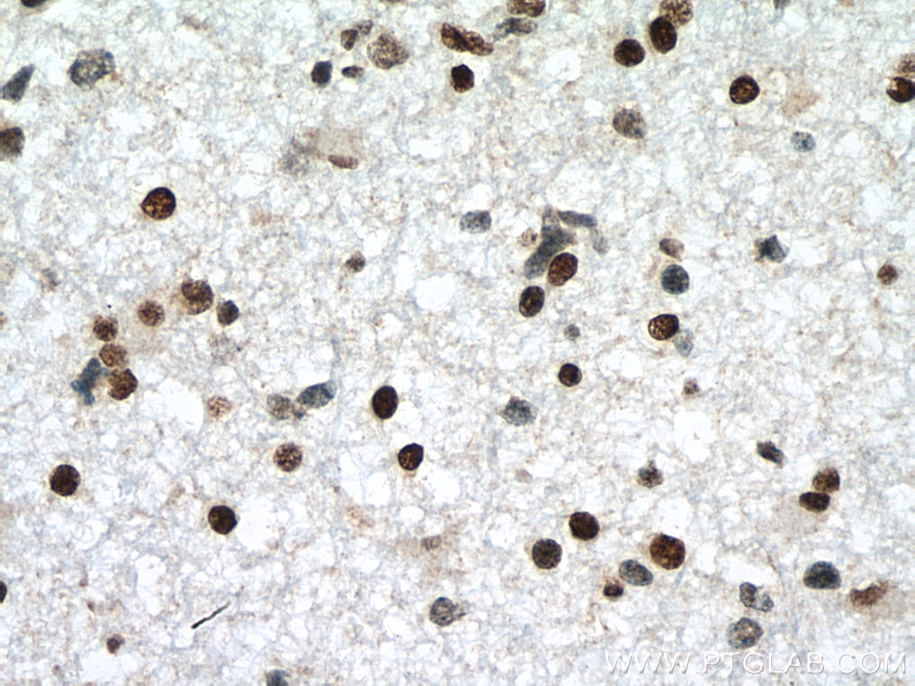 IHC staining of human gliomas using 10861-1-AP