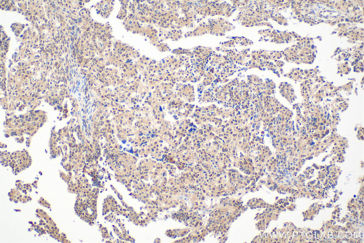 Immunohistochemical analysis of paraffin-embedded human ovary cancer tissue slide using 33366-1-AP (MED29 antibody) at dilution of 1:400 (under 20x lens). Heat mediated antigen retrieval with Tris-EDTA buffer (pH 9.0). IHC staining of human ovary cancer using 33366-1-AP