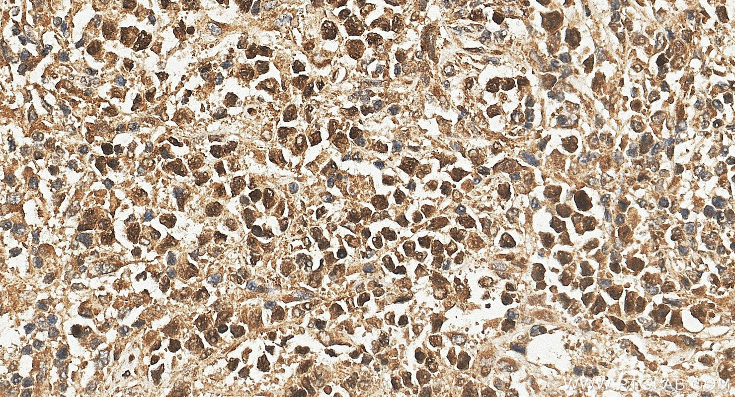 IHC staining of human lymphoma using 10056-1-AP IHC staining of human lymphoma using 10056-1-AP