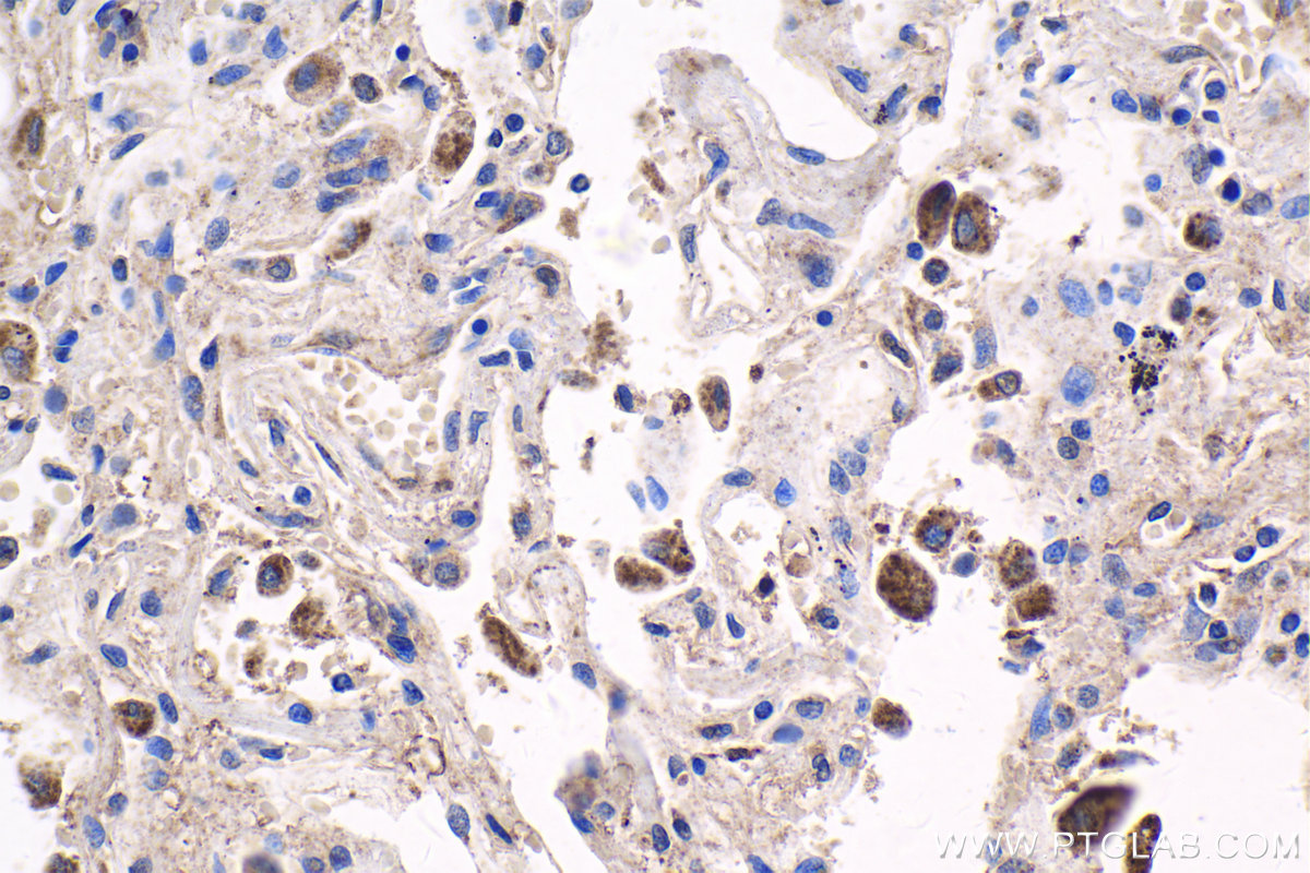 IHC staining of human lung using 20326-1-AP IHC staining of human lung using 20326-1-AP