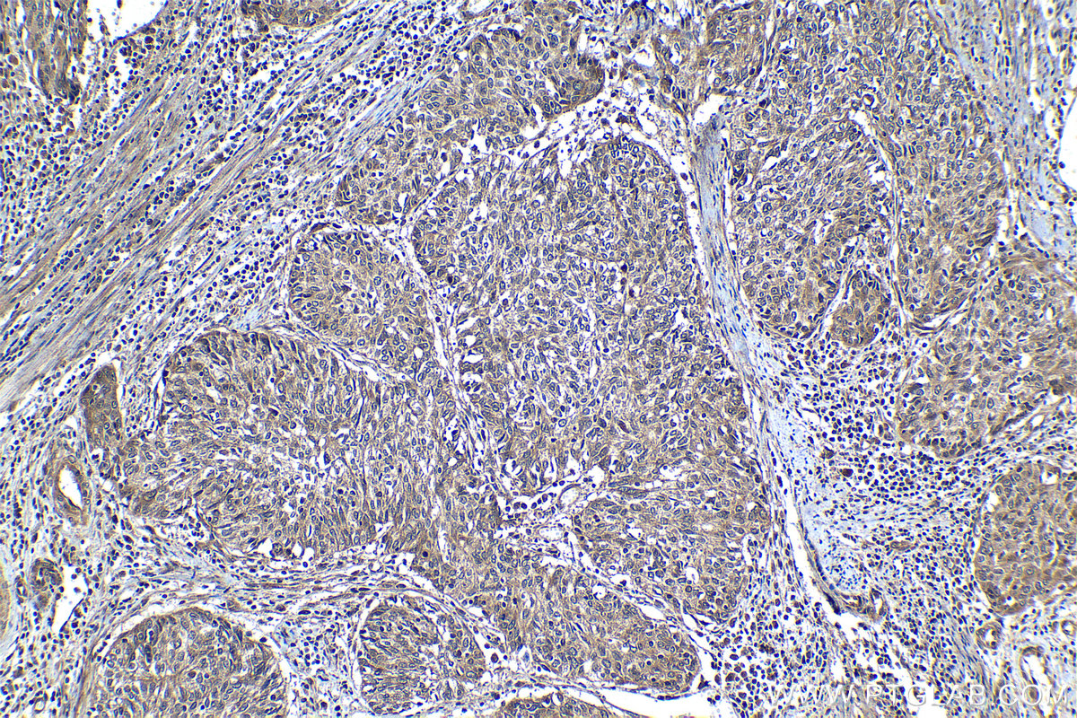 IHC staining of human cervical cancer using 13456-1-AP