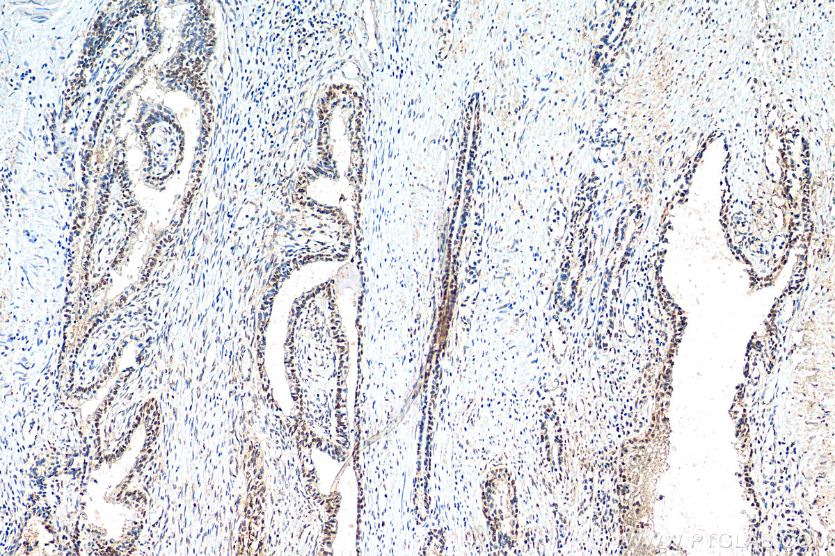 IHC staining of human prostate cancer using 11550-1-AP