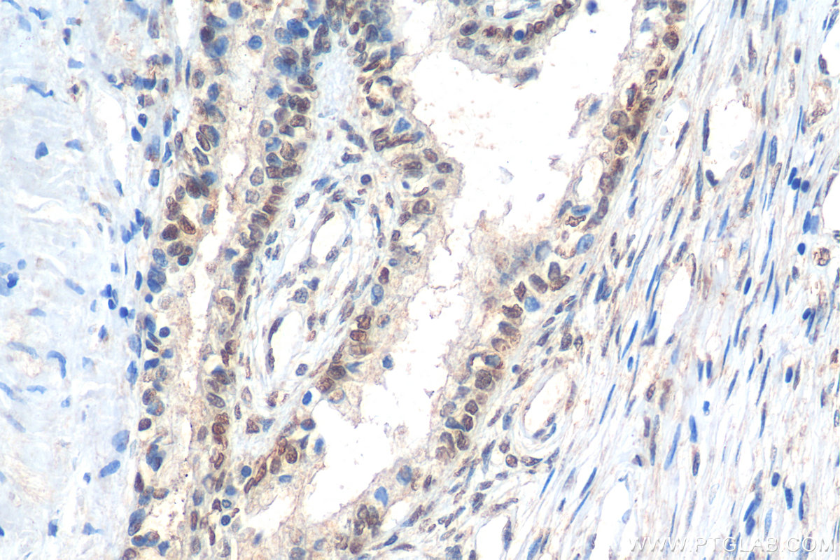 IHC staining of human prostate cancer using 11550-1-AP