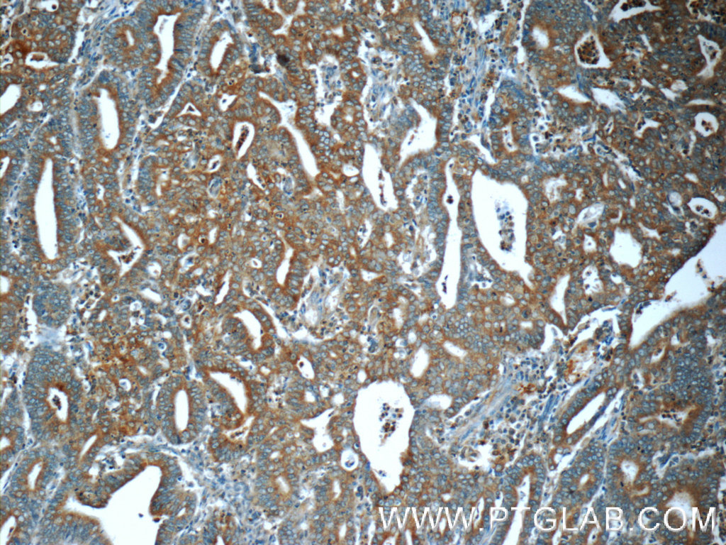 IHC staining of human endometrial cancer using 51080-1-AP
