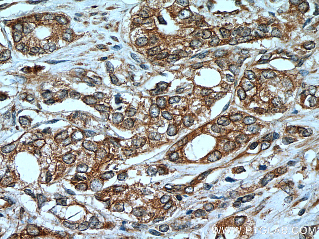 IHC staining of human prostate cancer using 60263-1-Ig