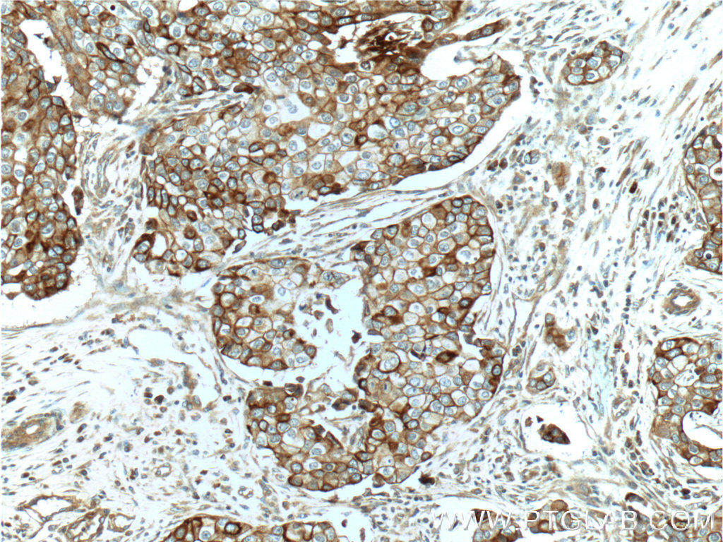 IHC staining of human breast cancer using 19971-1-AP