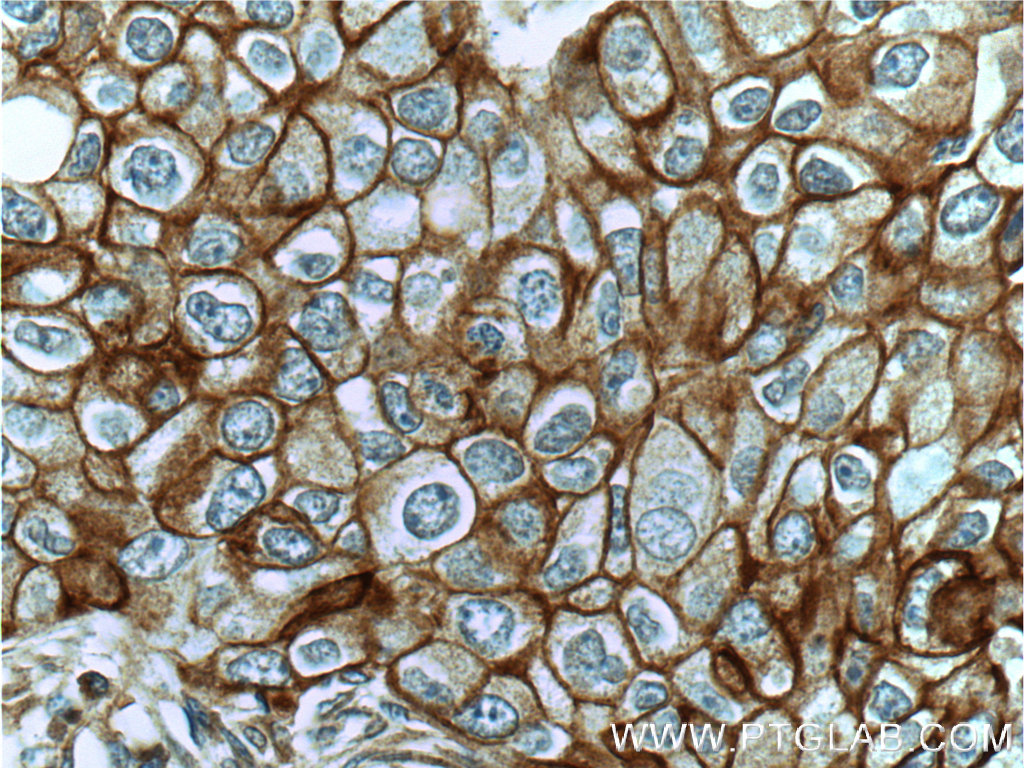 IHC staining of human breast cancer using 19971-1-AP