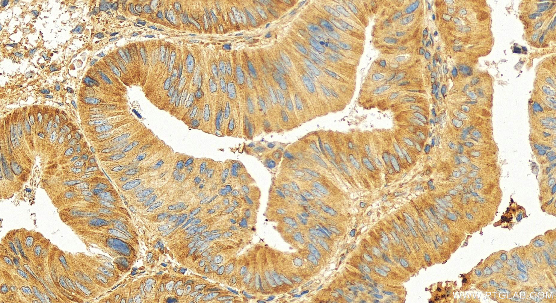 Immunohistochemical analysis of paraffin-embedded human colon cancer slide using 17040-1-AP (METAP2 antibody) at dilution of 1:100 (under 20x lens). Heat mediated antigen retrieval with Tris-EDTA buffer (pH 9.0). IHC staining of human colon cancer using 17040-1-AP
