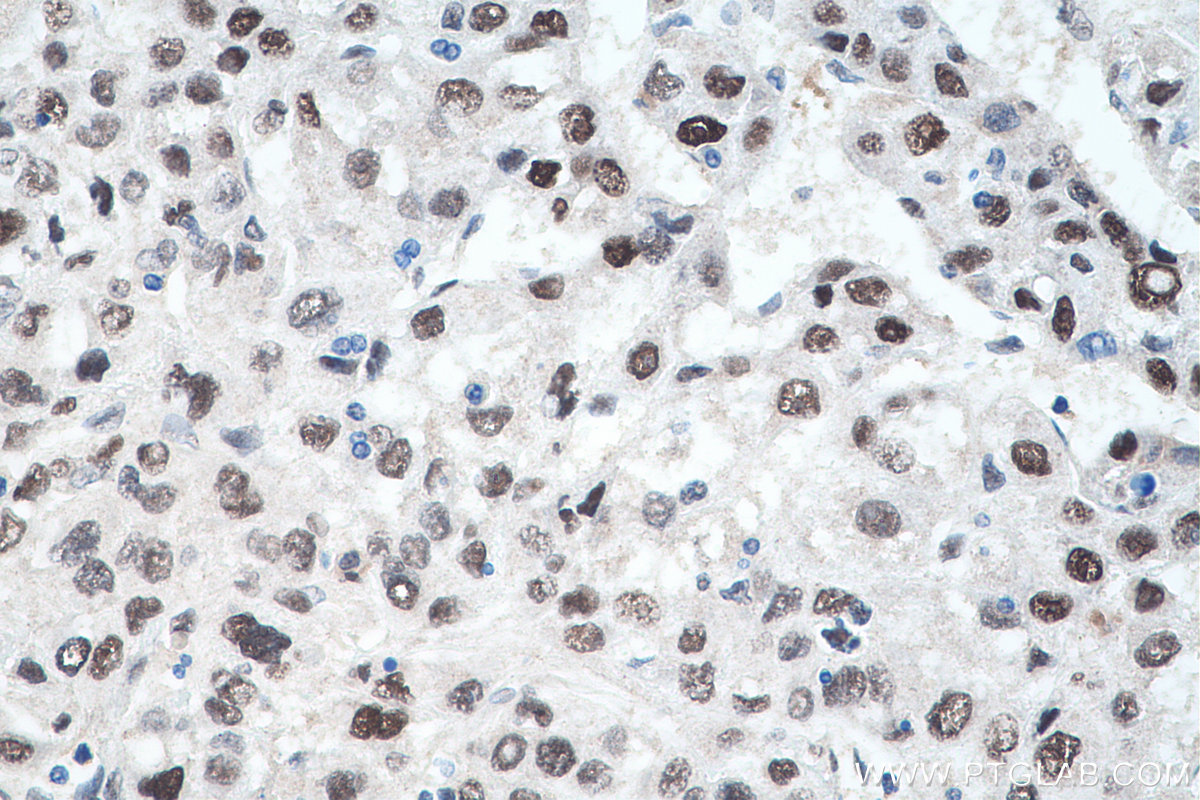 IHC staining of human liver cancer using 14994-1-AP
