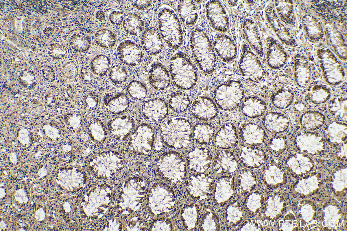 IHC staining of human colon cancer using 80790-1-RR (same clone as 80790-1-PBS)
