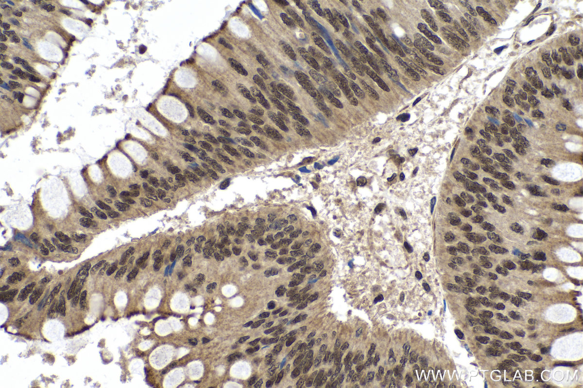 IHC staining of human colon cancer using 80790-1-RR (same clone as 80790-1-PBS)