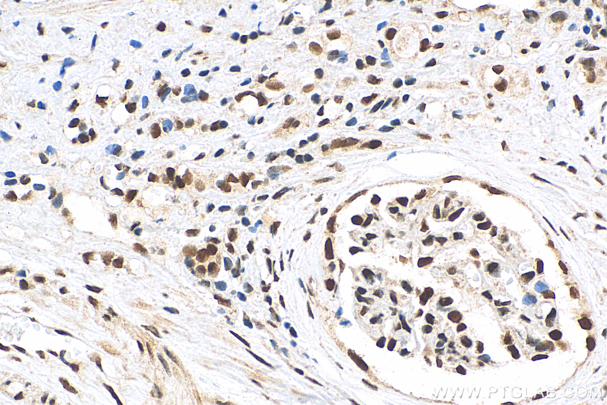 IHC staining of human renal cell carcinoma using 15073-1-AP