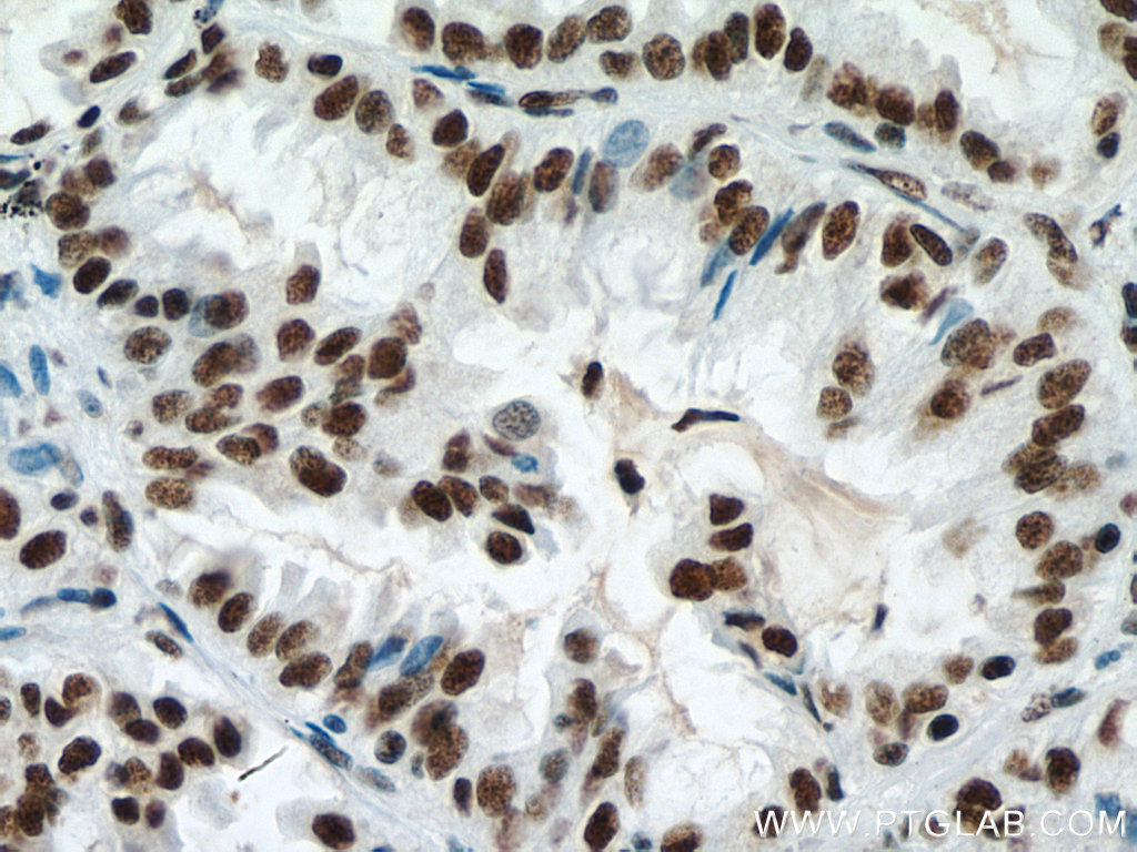 IHC staining of human lung cancer using 67733-1-Ig (same clone as 67733-1-PBS)