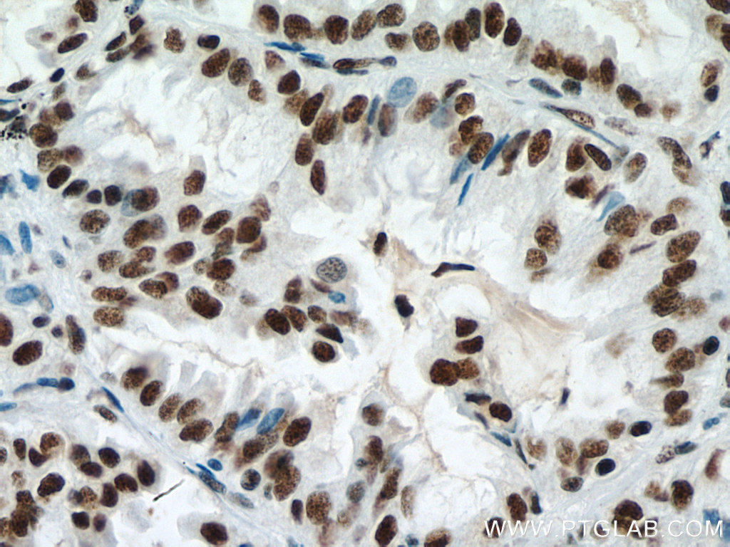 IHC staining of human lung cancer using 67733-1-Ig