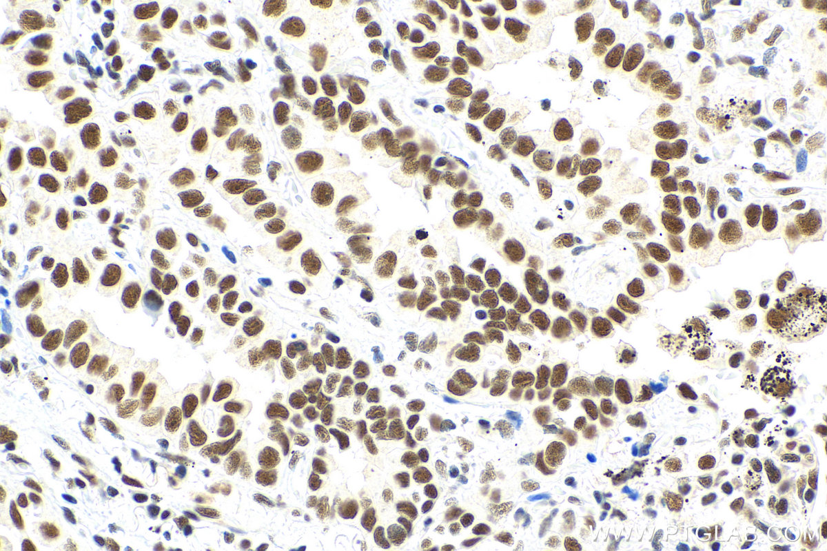 IHC staining of human lung cancer using 80323-1-RR