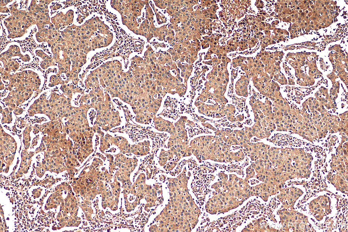 IHC staining of human breast cancer using 68400-1-Ig