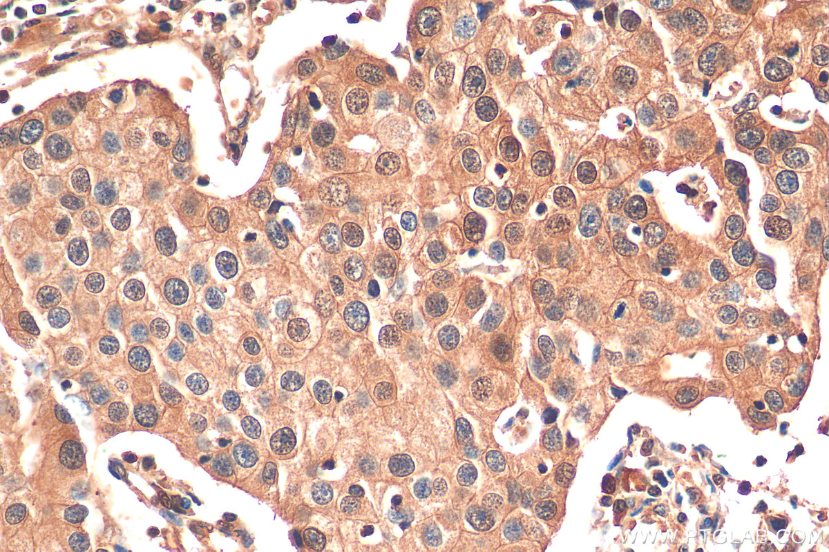 IHC staining of human breast cancer using 68400-1-Ig (same clone as 68400-1-PBS)