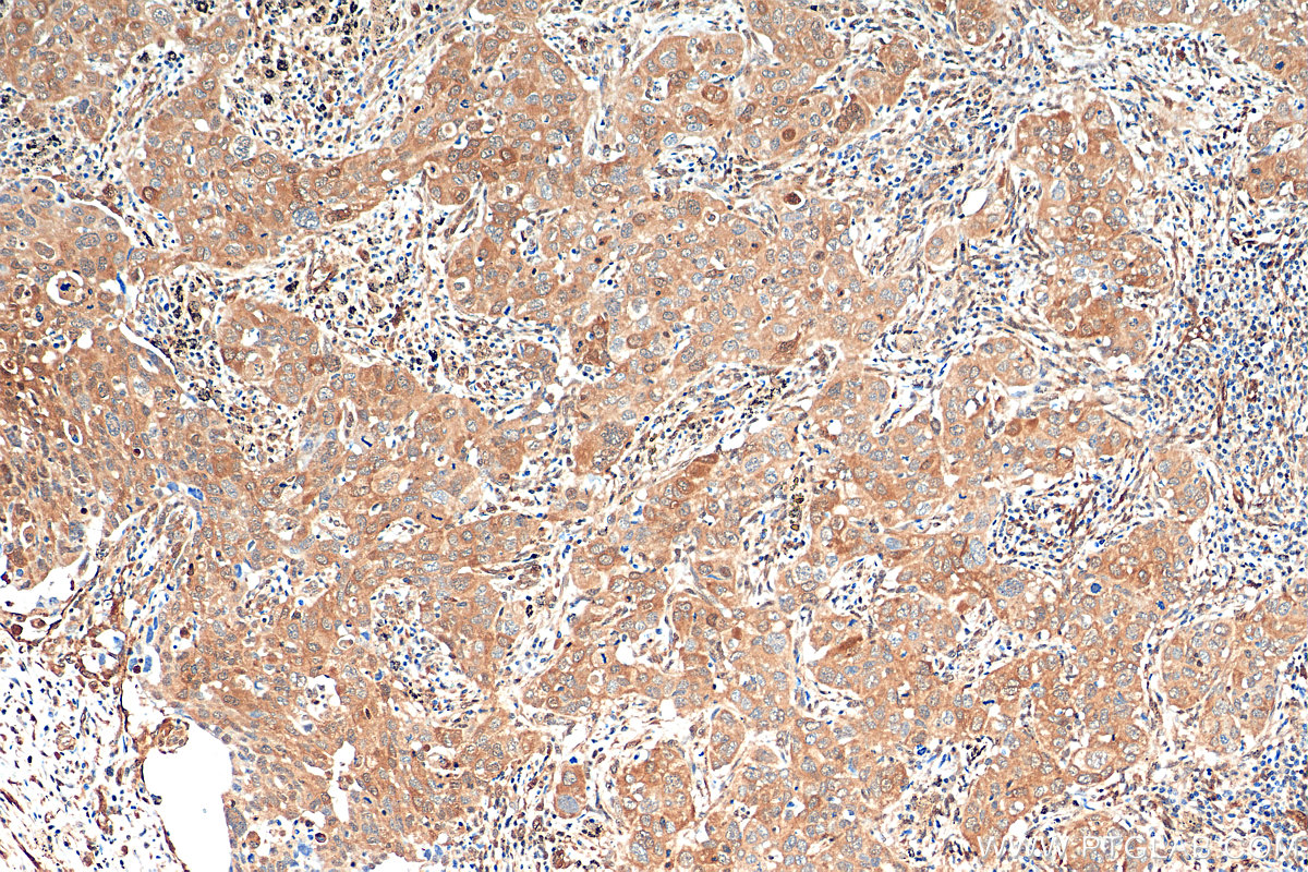 IHC staining of human lung cancer using 68400-1-Ig