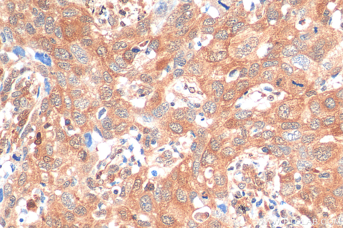 IHC staining of human lung cancer using 68400-1-Ig (same clone as 68400-1-PBS)
