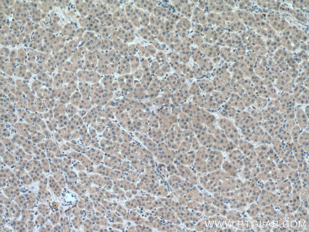 IHC staining of human liver cancer using 17092-1-AP