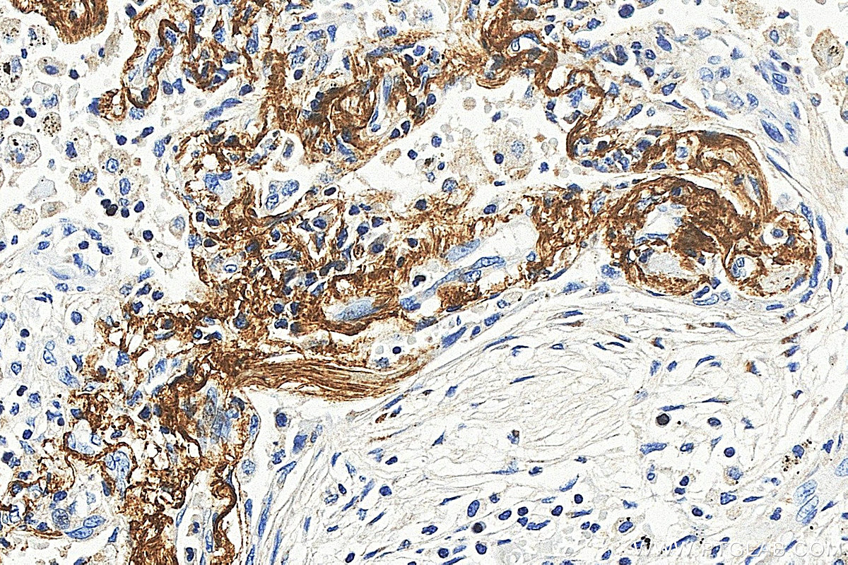 IHC staining of human lung using 88535-1-RR (same clone as 88535-1-PBS) IHC staining of human lung using 88535-1-RR (same clone as 88535-1-PBS)