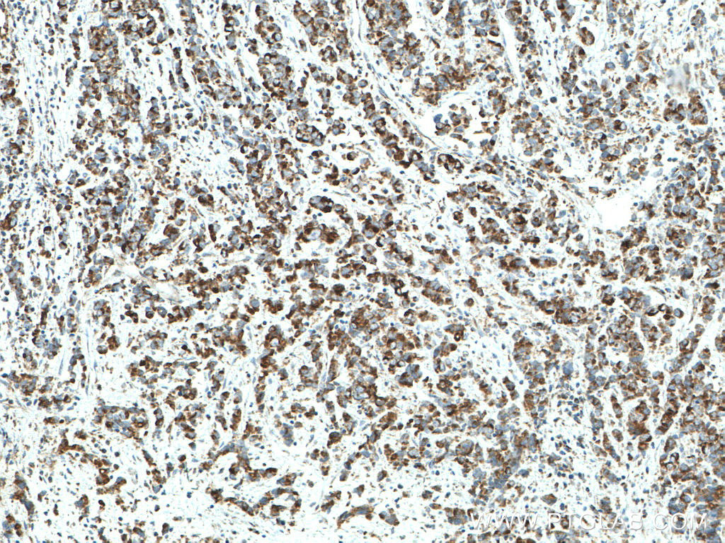 IHC staining of human prostate cancer using 66776-1-Ig (same clone as 66776-1-PBS)