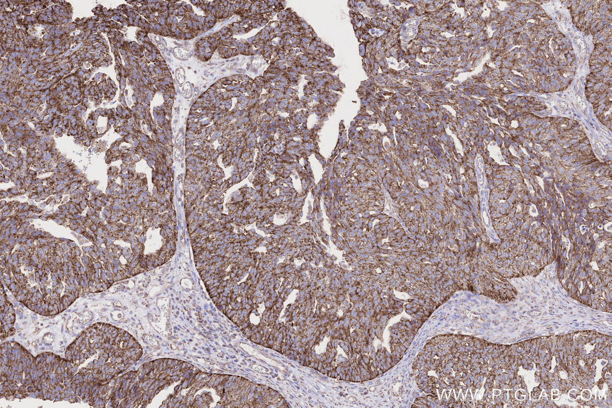 IHC staining of human ovary cancer using 66776-1-Ig IHC staining of human ovary cancer using 66776-1-Ig