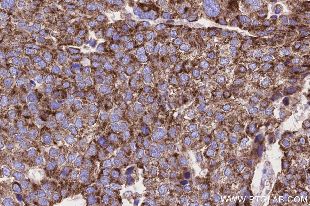 IHC staining of human stomach cancer using 66776-1-Ig IHC staining of human stomach cancer using 66776-1-Ig