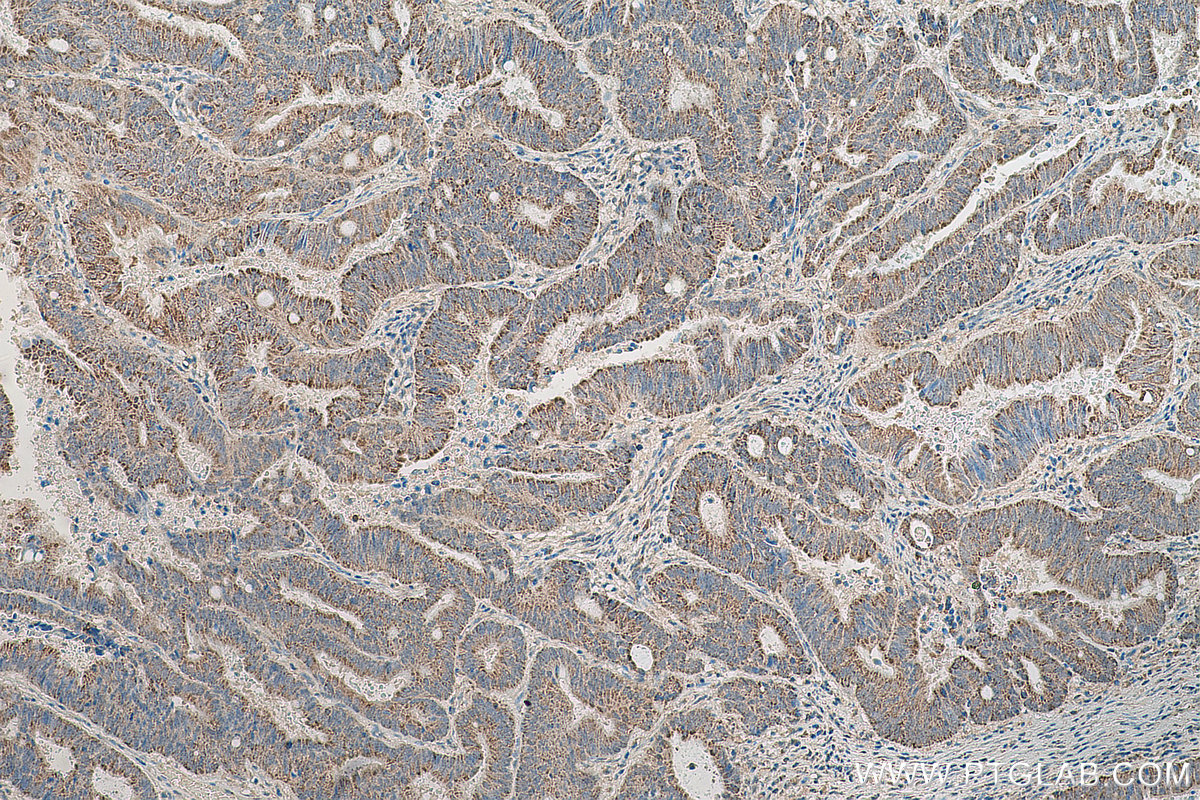 IHC staining of human colon cancer using 12186-1-AP