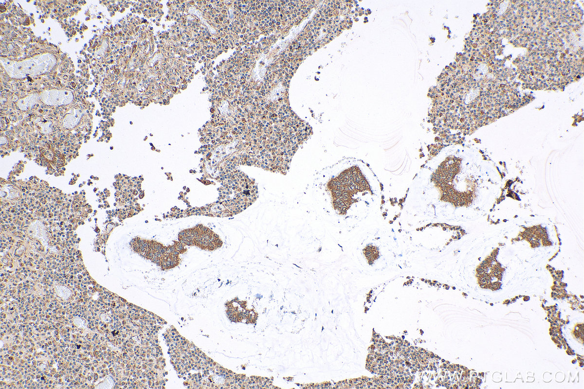 IHC staining of human colon cancer using 17869-1-AP