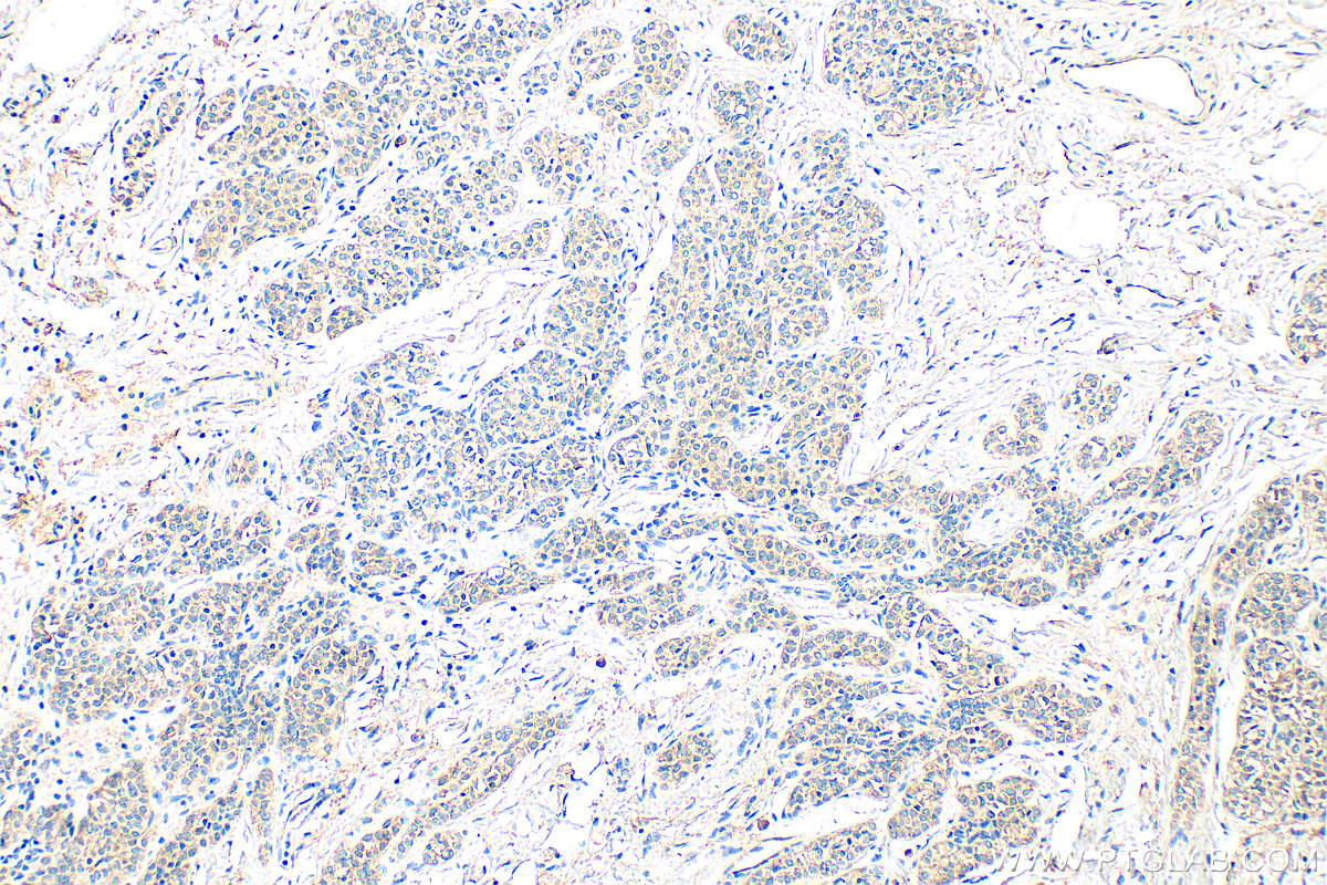 IHC staining of human breast cancer using 25109-1-AP