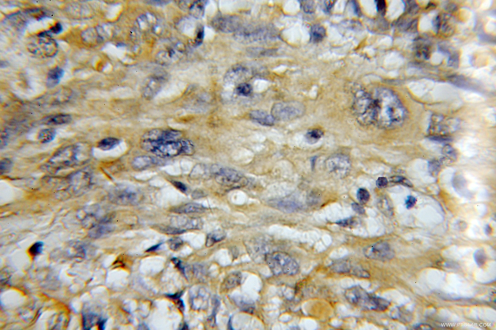 IHC staining of human gliomas using 11454-1-AP (same clone as 11454-1-PBS)