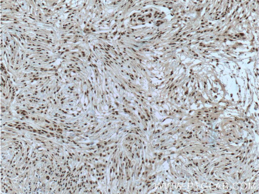 IHC staining of human meningioma using 66033-1-Ig