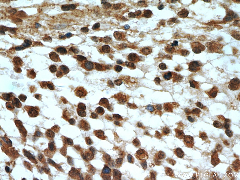 IHC staining of human gliomas using 66033-1-Ig