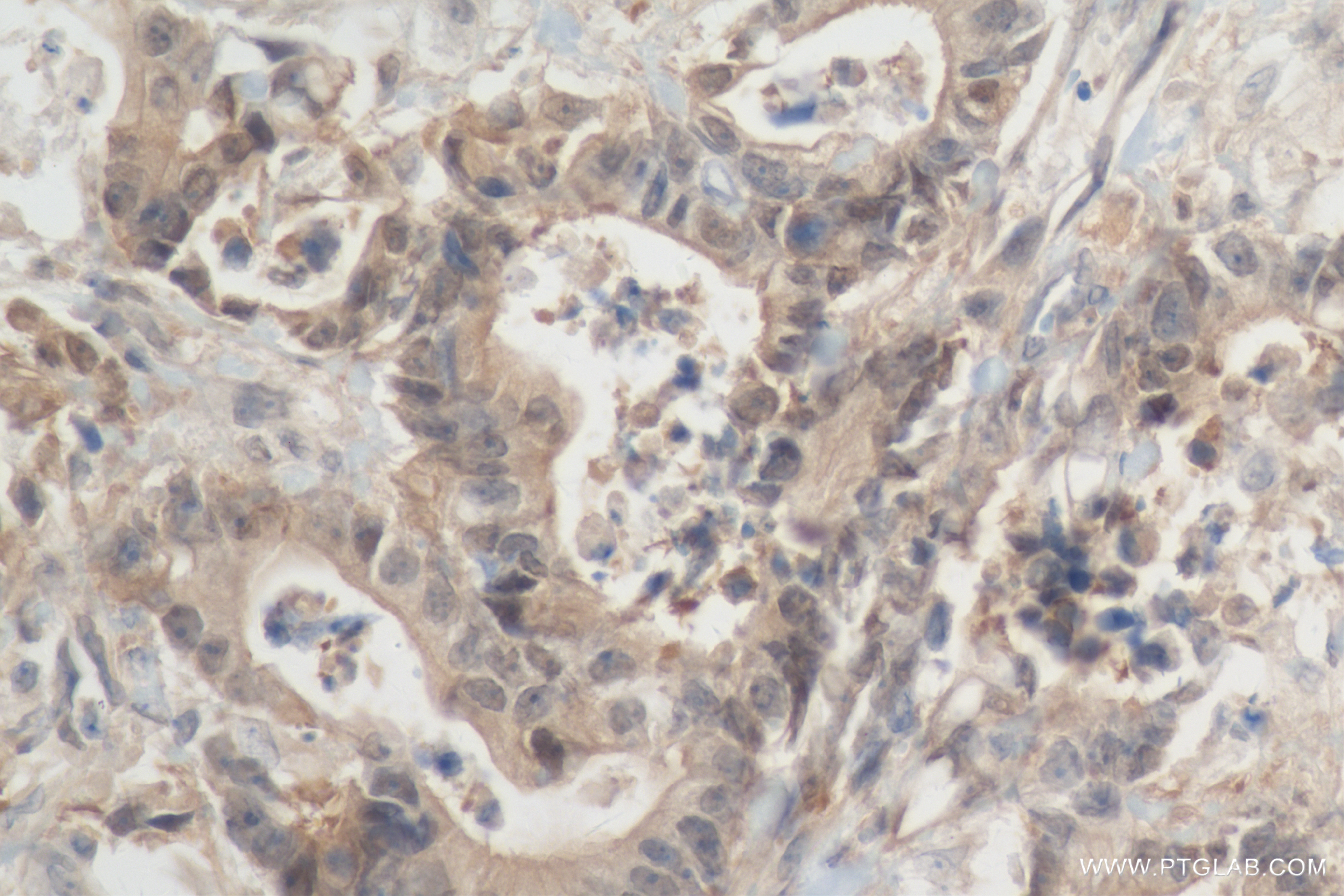 IHC staining of human rectal cancer using 84722-4-RR (same clone as 84722-4-PBS)
