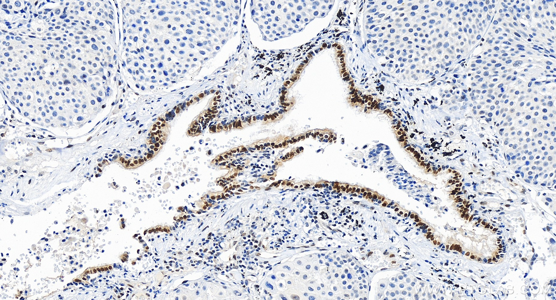 IHC staining of human lung cancer using 86115-5-RR (same clone as 86115-5-PBS)