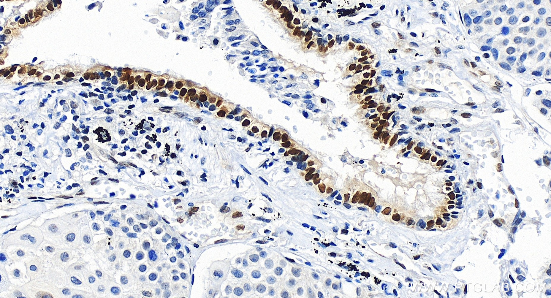 IHC staining of human lung cancer using 86115-5-RR (same clone as 86115-5-PBS)