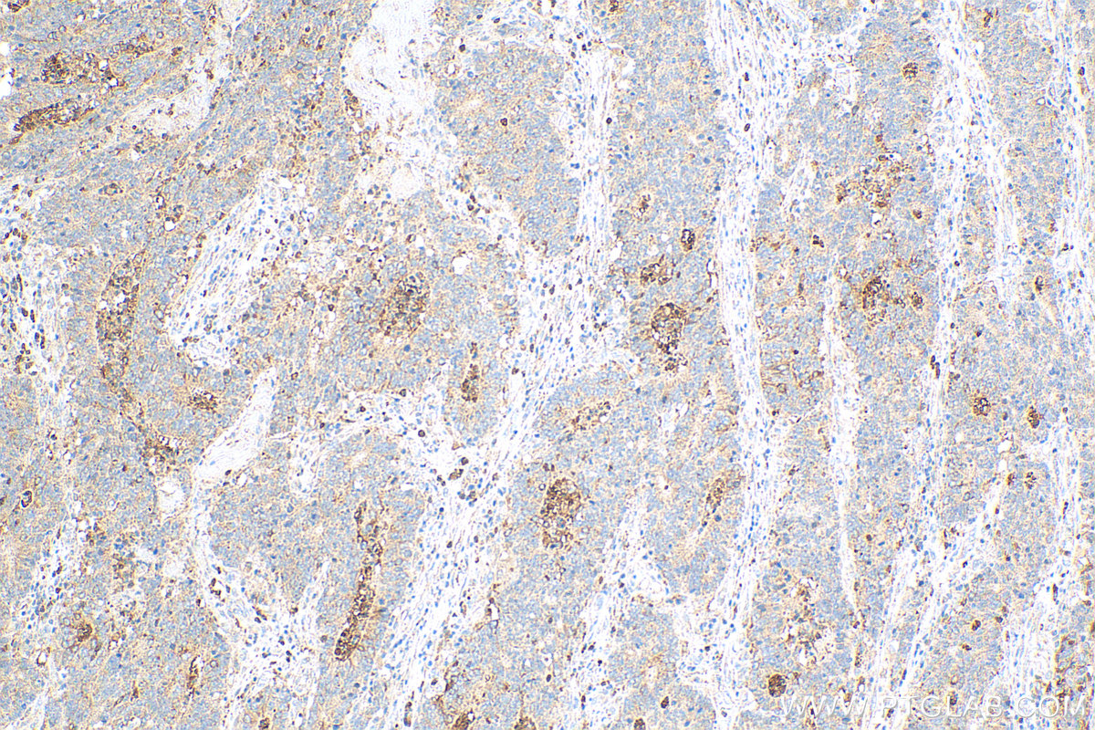 IHC staining of human colon cancer using 10734-1-AP