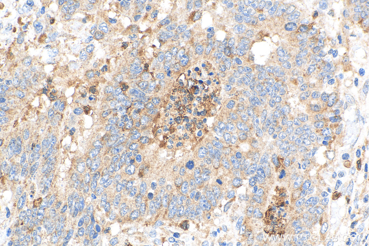 IHC staining of human colon cancer using 10734-1-AP
