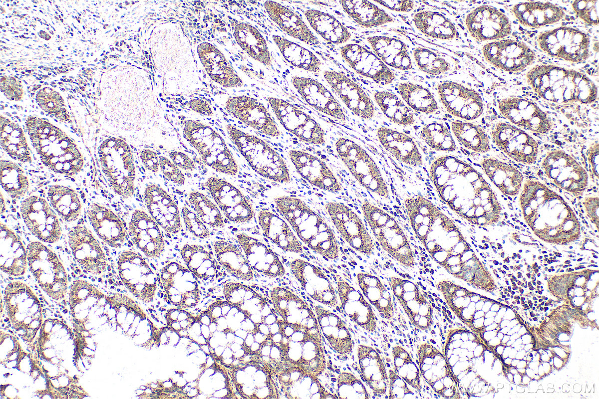 IHC staining of human rectal cancer using 10734-1-AP