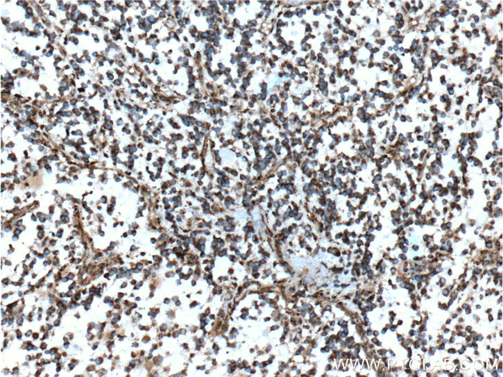 IHC staining of human gliomas using 60055-1-Ig (same clone as 60055-1-PBS)