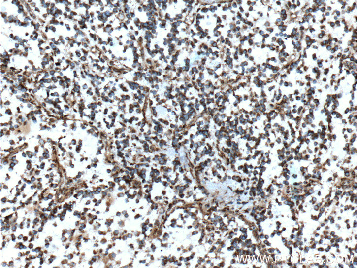 IHC staining of human gliomas using 60055-1-Ig