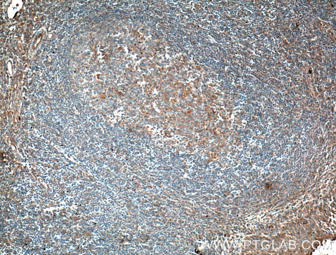 IHC staining of human tonsillitis using 66384-1-Ig (same clone as 66384-1-PBS)