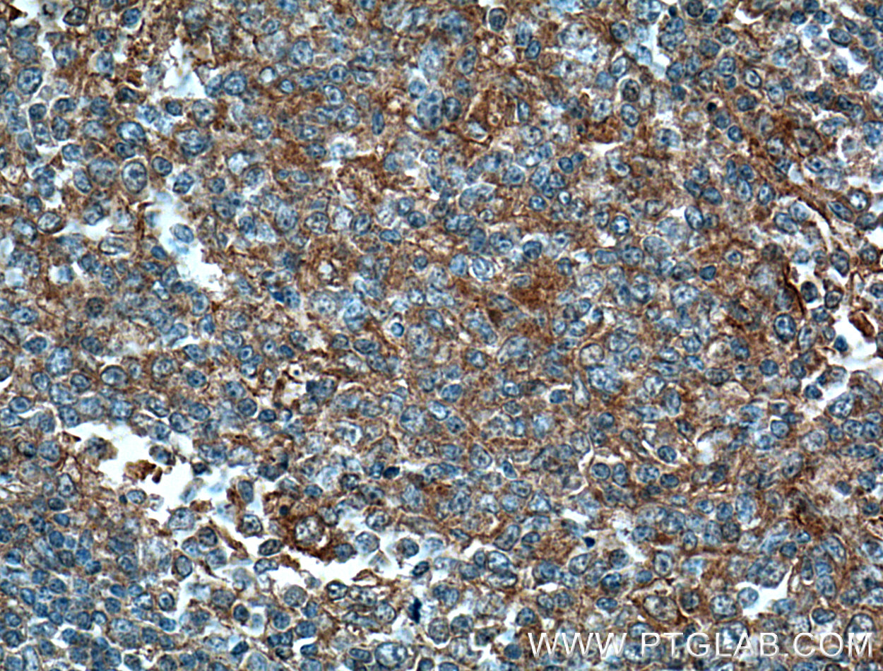 IHC staining of human tonsillitis using 66384-1-Ig