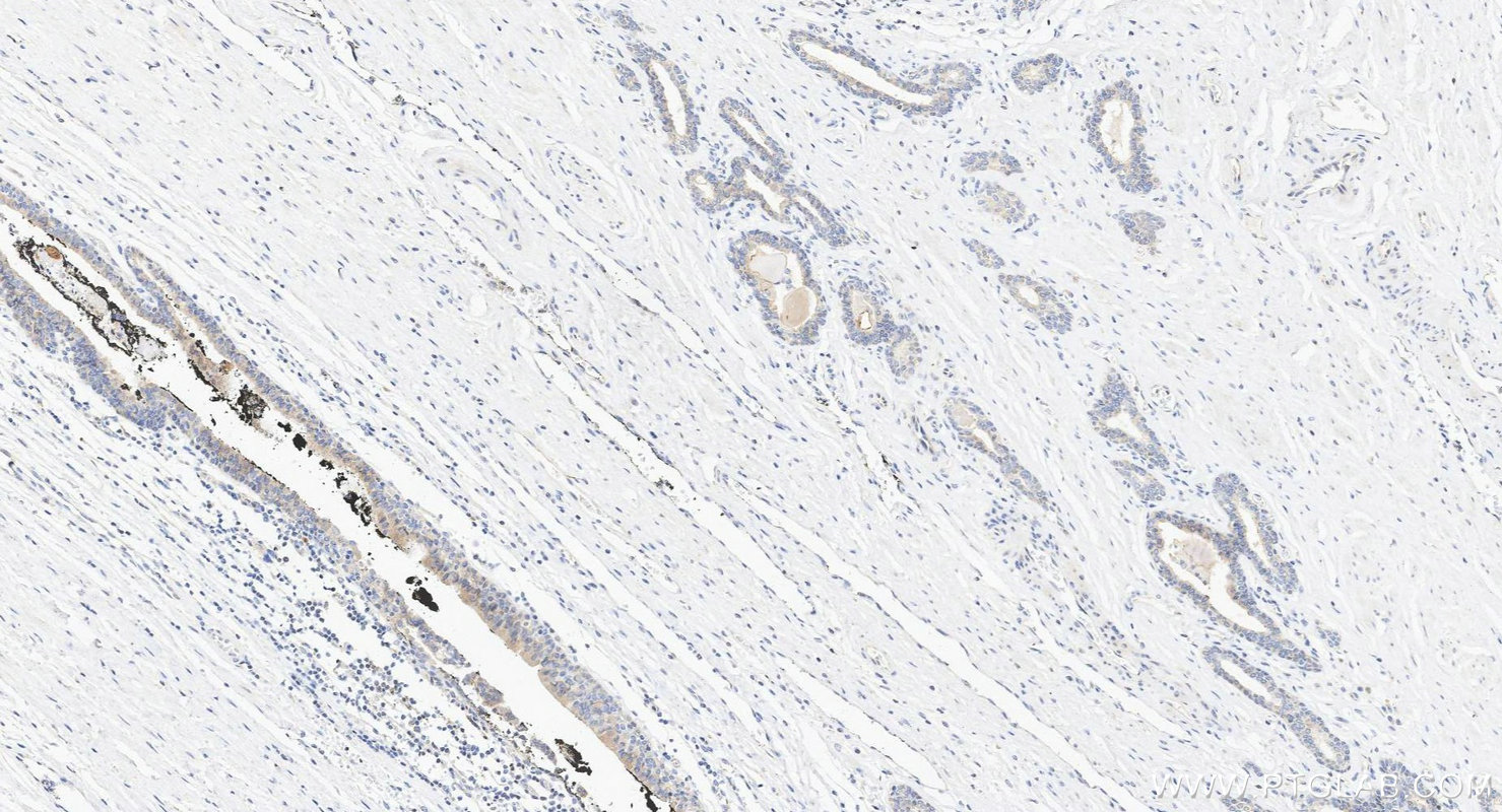IHC staining of human prostate cancer using 22355-1-AP IHC staining of human prostate cancer using 22355-1-AP