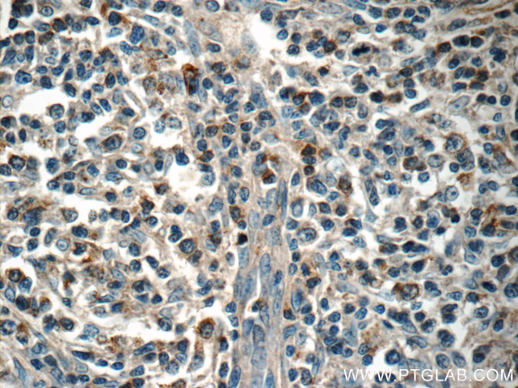 IHC staining of human lymphoma using 13137-1-AP