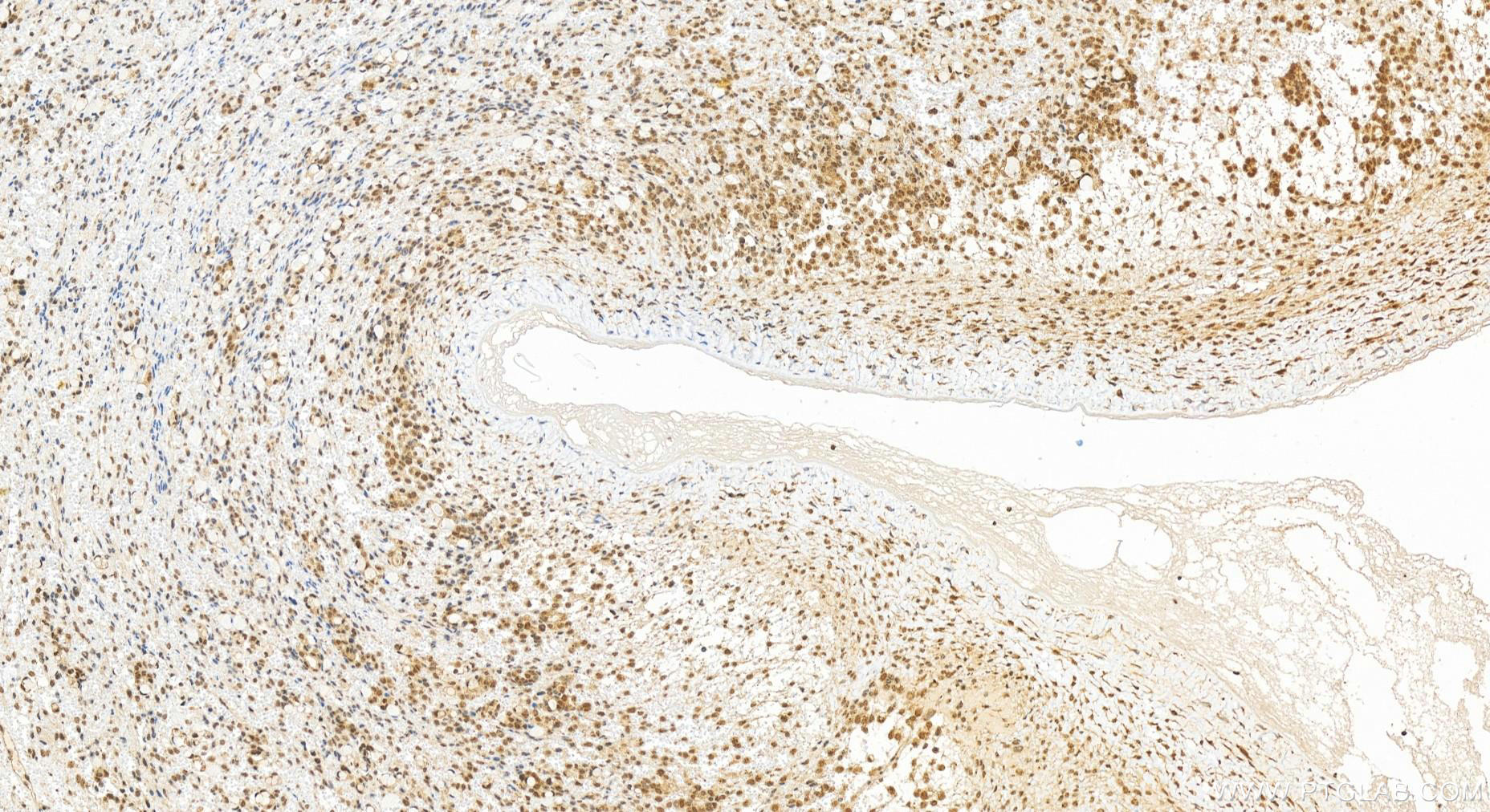 Immunohistochemical analysis of paraffin-embedded human ovary cancer tissue slide using 19820-1-AP (MIS12 antibody) at dilution of 1:400 (under 20x lens). Heat mediated antigen retrieval with Tris-EDTA buffer (pH 9.0). IHC staining of human ovary cancer using 19820-1-AP