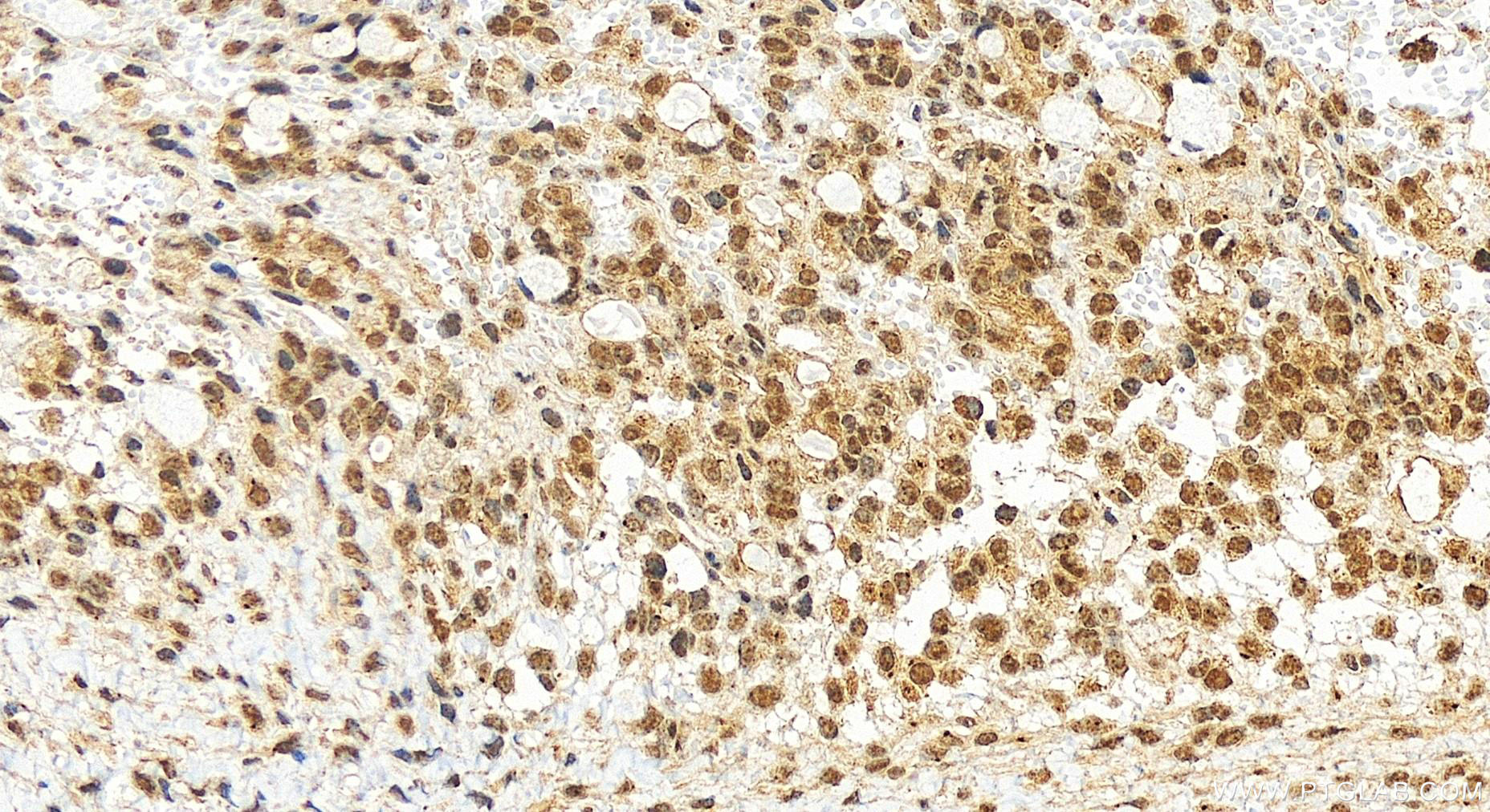 Immunohistochemical analysis of paraffin-embedded human ovary cancer tissue slide using 19820-1-AP (MIS12 antibody) at dilution of 1:400 (under 20x lens). Heat mediated antigen retrieval with Tris-EDTA buffer (pH 9.0). IHC staining of human ovary cancer using 19820-1-AP
