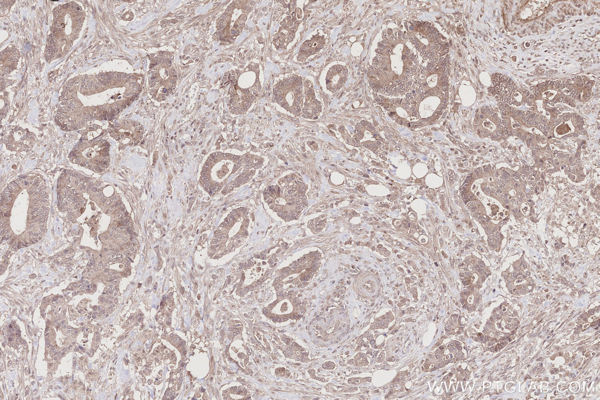 IHC staining of human rectal cancer using 17264-1-AP IHC staining of human rectal cancer using 17264-1-AP